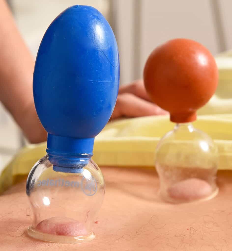 Stehendes Schröpfen BaGuan mit Sauggläsern aus Glas auf AKupunkturpunkten oder Schmerzpunkten